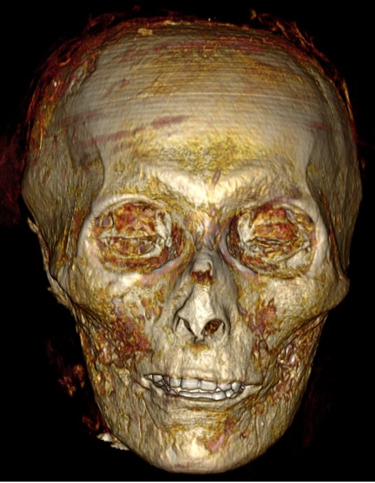 Tomografia do crânio de Amenófis