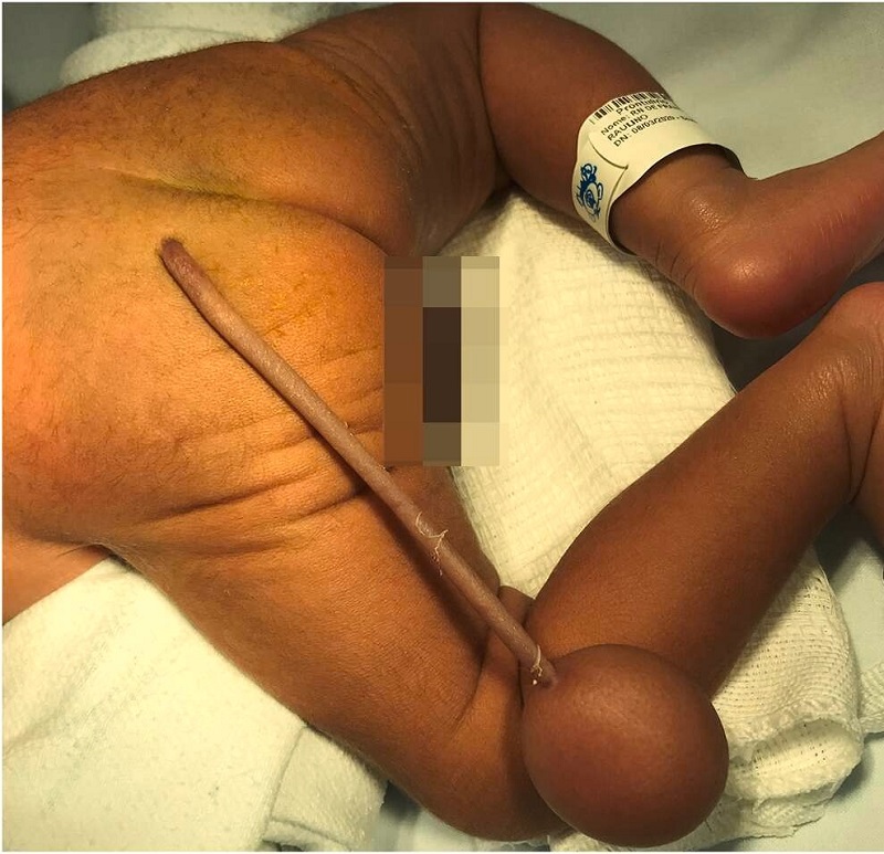 Bebê nasceu com cauda no Ceará