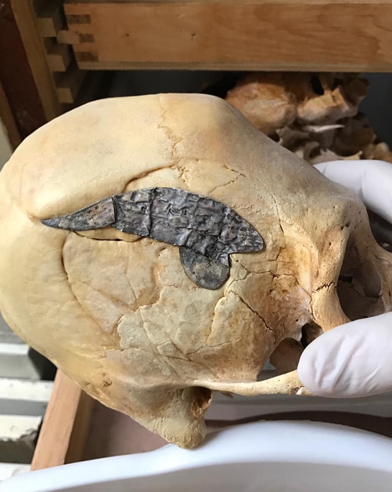Crânio alongado com implante de metal