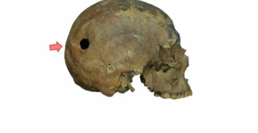 Evidência de cirurgia craniana é encontrada no sarcófago de Alexandria-0
