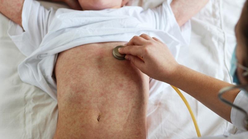 Movimentos antivacina fazem surgir epidemia de sarampo em Nova York-0