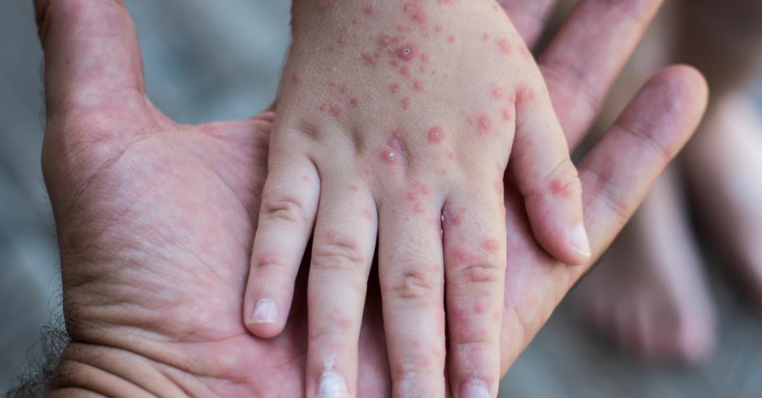 Mulher perde dois filhos para o sarampo por acreditar em notícias falsas sobre vacinas-0
