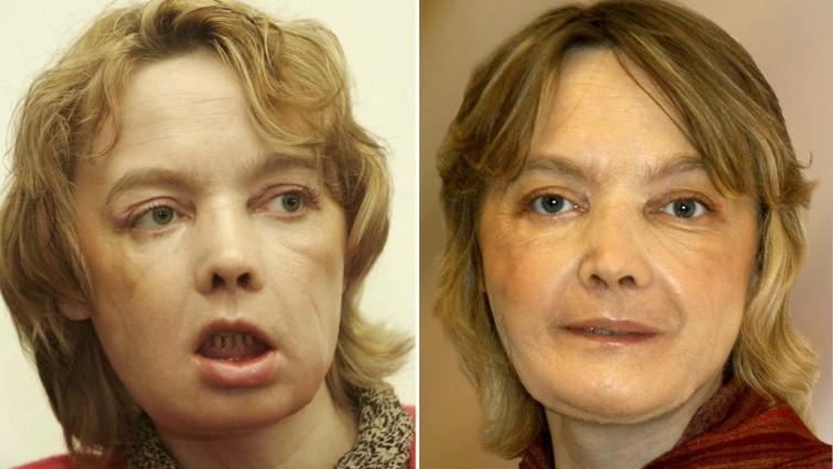 Primeiro transplante parcial de face é realizado na França-0