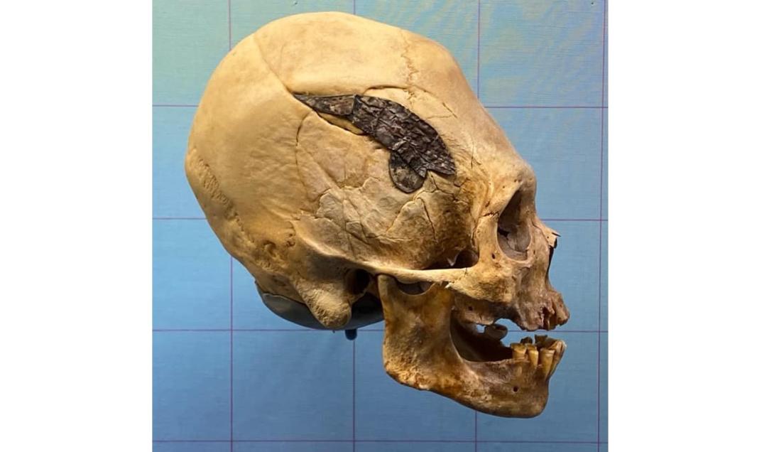 Misterioso crânio alongado de 2 mil anos com implante de metal intriga pesquisadores-0
