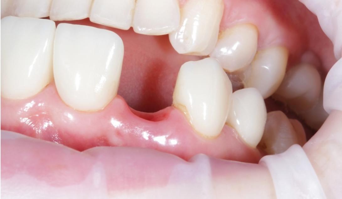 Adeus implantes dentários: medicamento que regenera dentes está em fase de testes-0