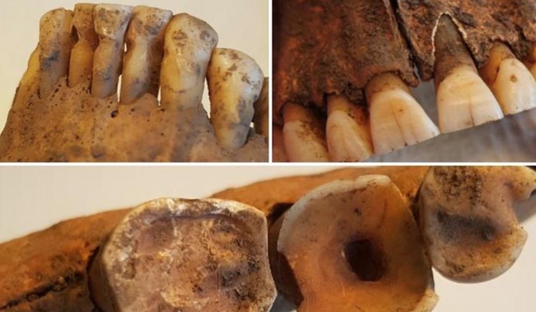 Análise de dentes de vikings indica que eles tinham uma odontologia avançada-0